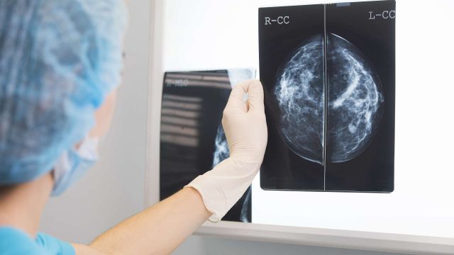 Imagen de archivo sobre el cáncer de mama.
