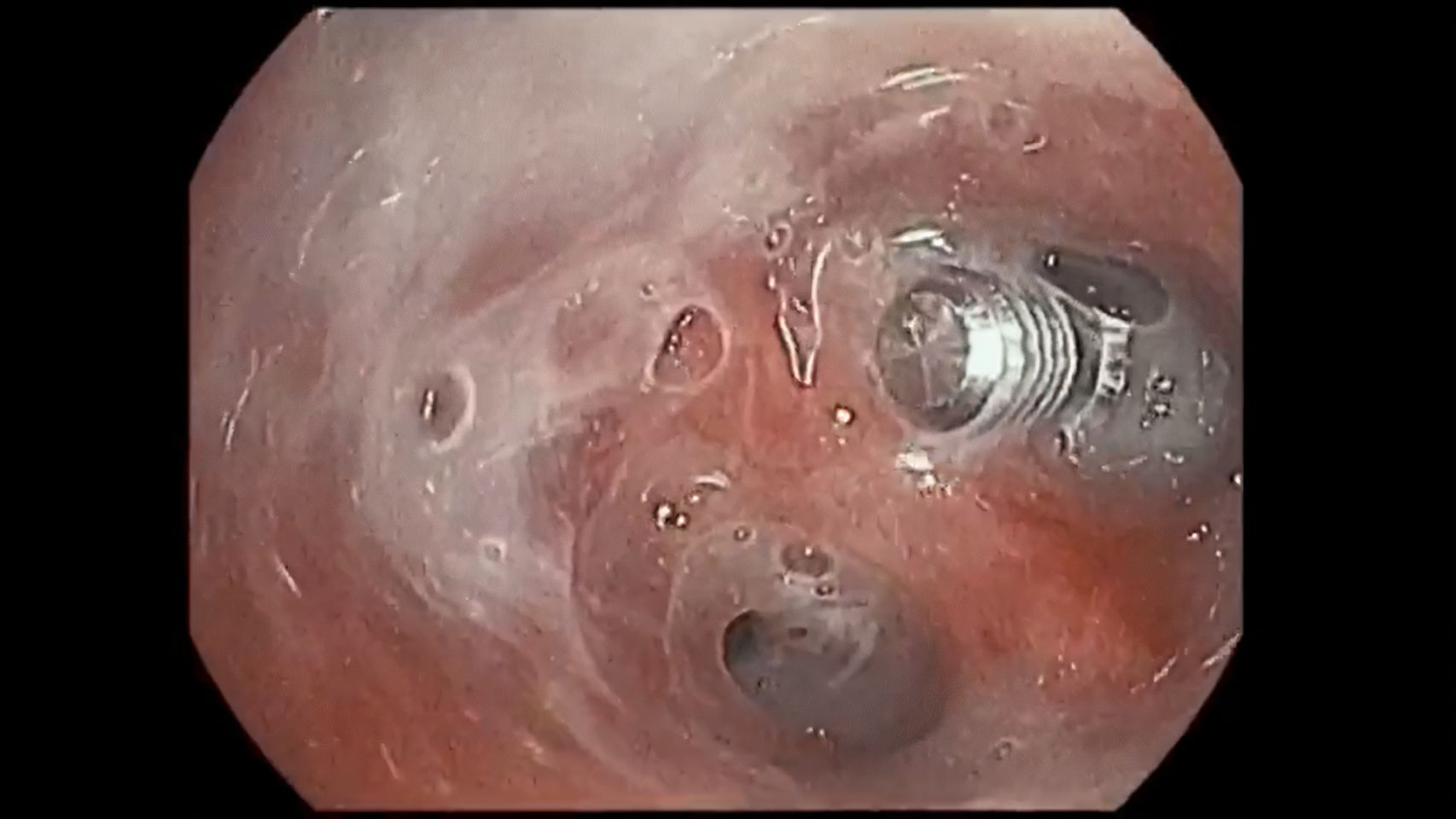 Imagen de los tornillos en los bronquios de la paciente.