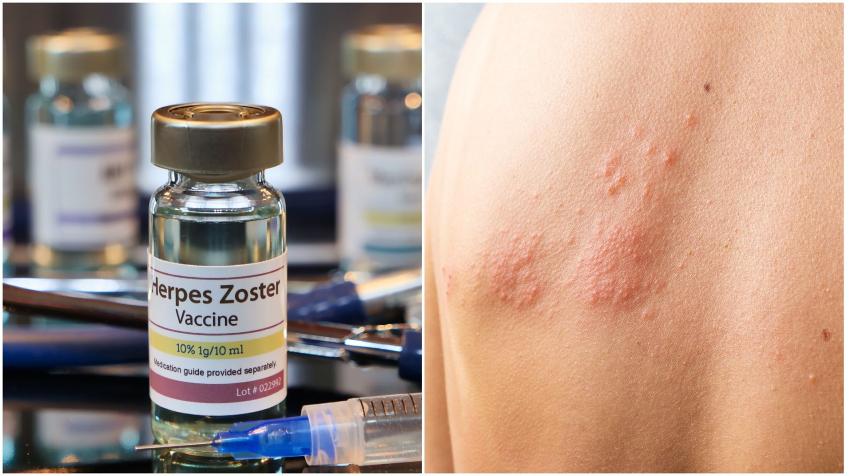 Los síntomas del herpes zóster son dolor y ampollas en la piel