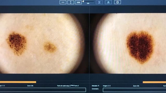 Imagen de una dermatoscopia digital